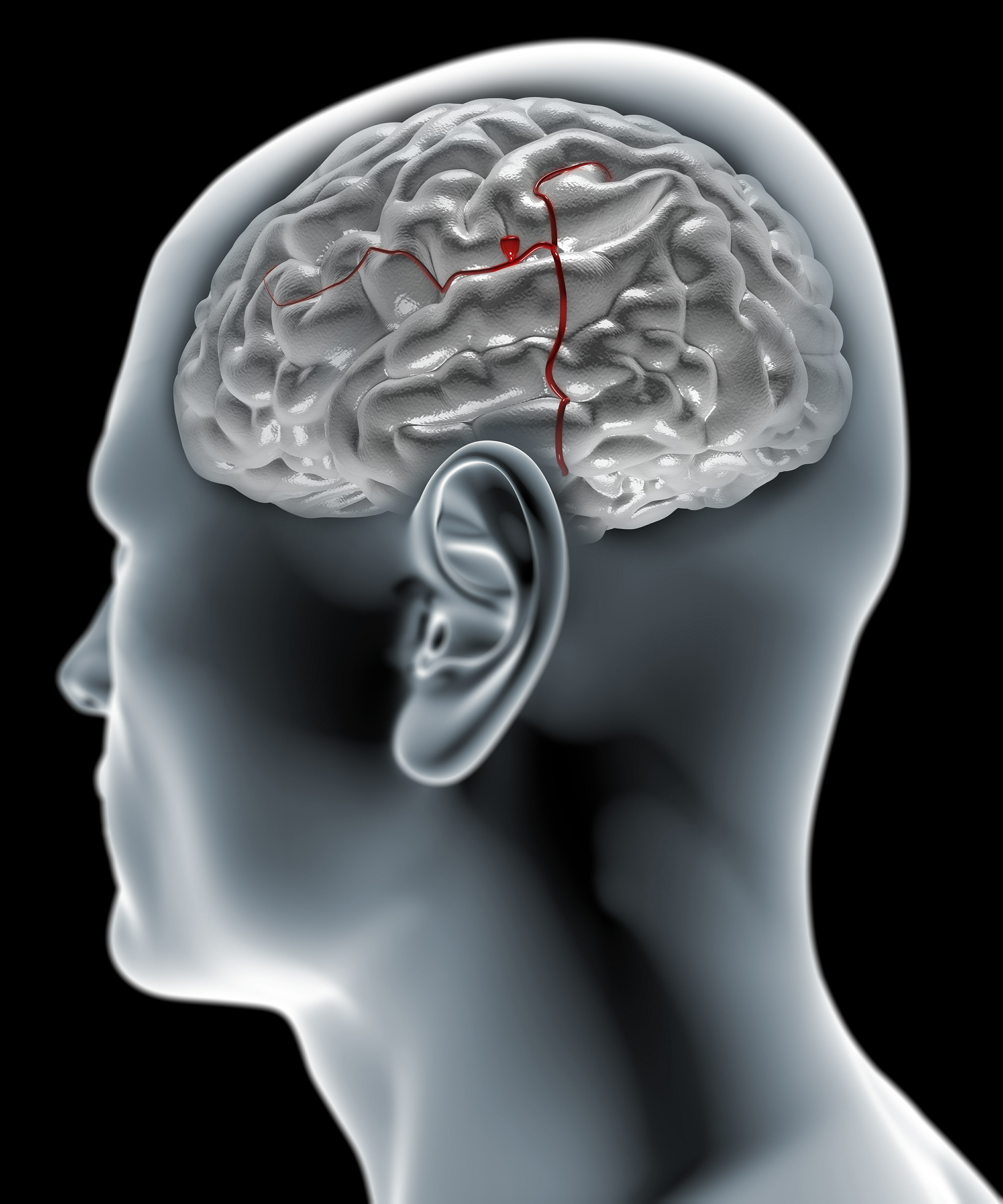 brain-aneurysm-5-things-to-know-about-this-health-issue-healthshots